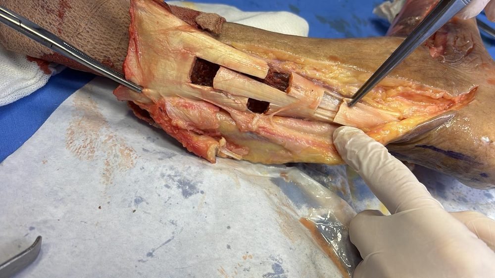 Disección detallada de estructuras tendinosas del antebrazo y la mano con instrumental quirúrgico